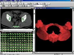 Volume Rendering of CT Pelvis